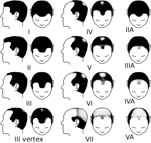 male pattern baldness